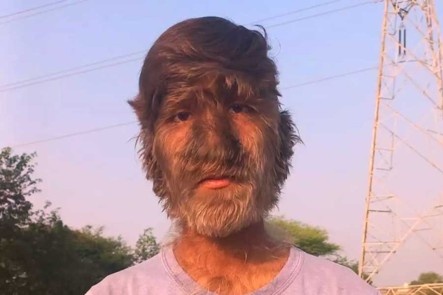 A teenage boy with a rare medical condition called Werewolf Syndrome 