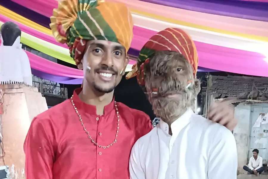 A teenage boy with a rare medical condition called Werewolf Syndrome 