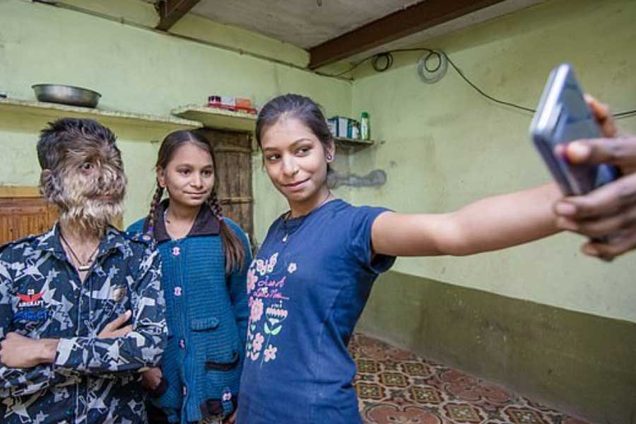 A teenage boy with a rare medical condition called Werewolf Syndrome 