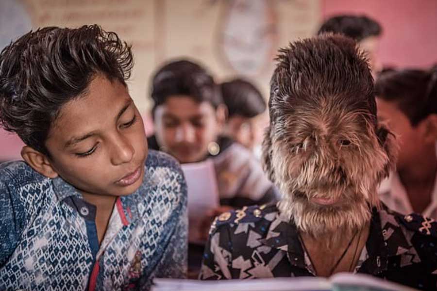A teenage boy with a rare medical condition called Werewolf Syndrome 