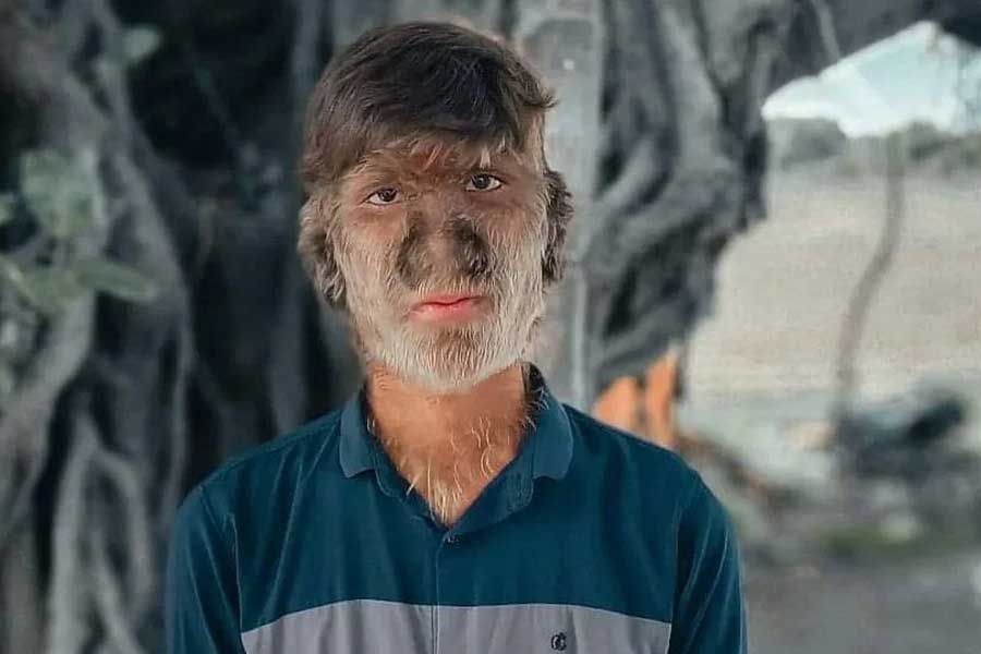 A teenage boy with a rare medical condition called Werewolf Syndrome 