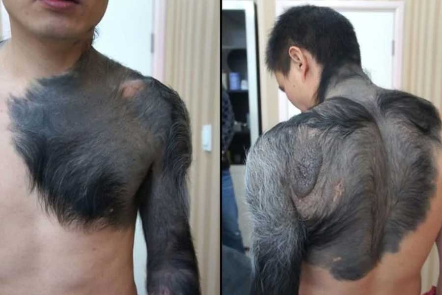 A teenage boy with a rare medical condition called Werewolf Syndrome 