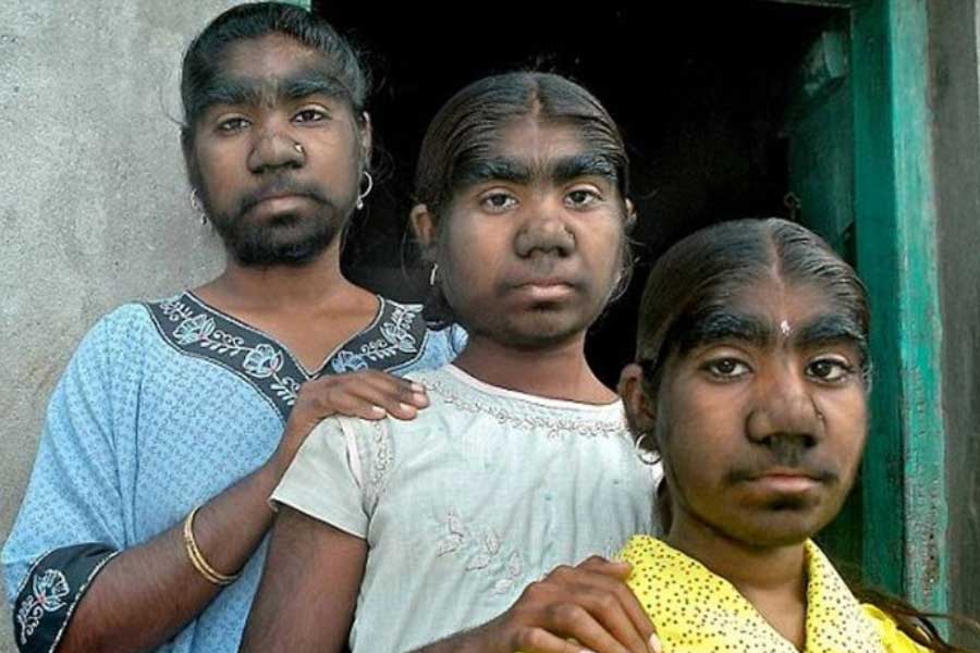 A teenage boy with a rare medical condition called Werewolf Syndrome 