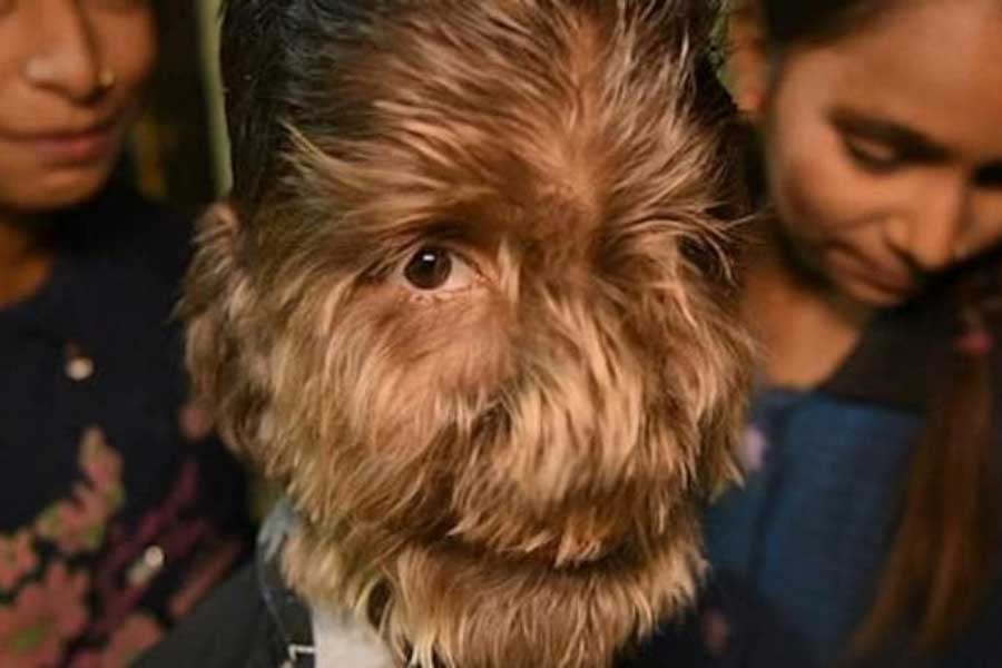 A teenage boy with a rare medical condition called Werewolf Syndrome 