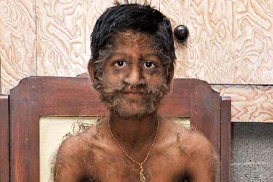 A teenage boy with a rare medical condition called Werewolf Syndrome 