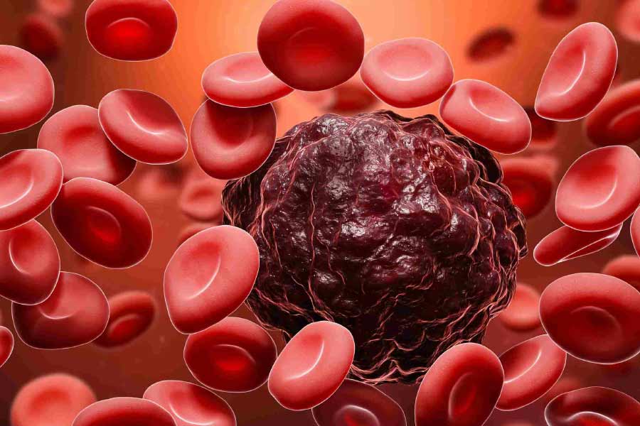 Tests and procedures used to diagnose chronic myelogenous leukemia