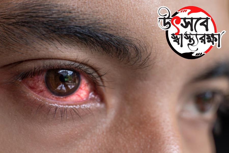 How to stay safe from conjunctivitis or red eyes before Durga puja