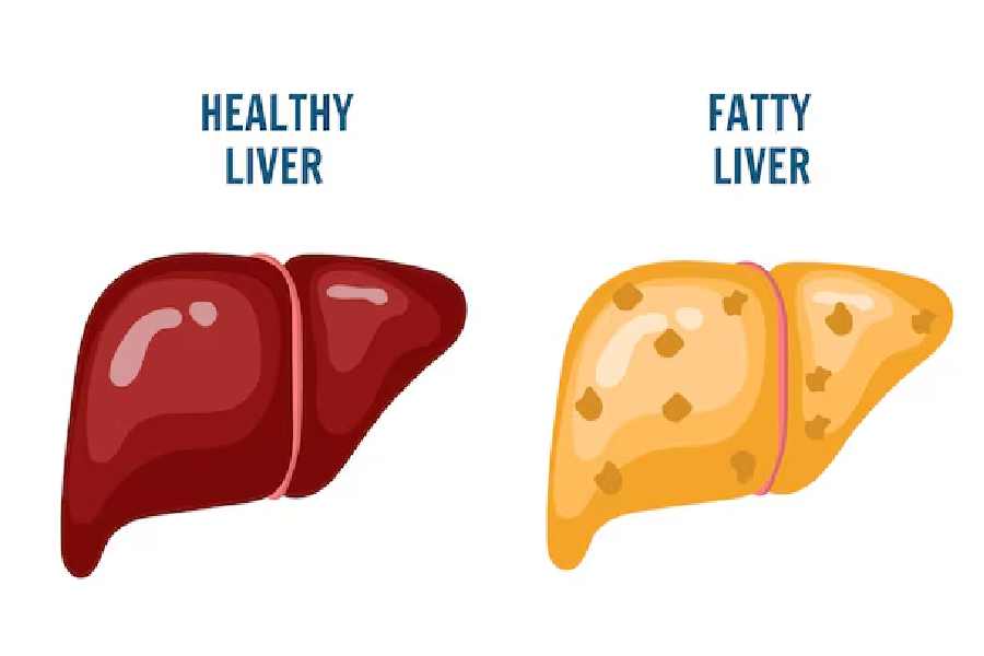 ফ্যাটি লিভার এড়াতে কী করবেন, কোনটা নয়?