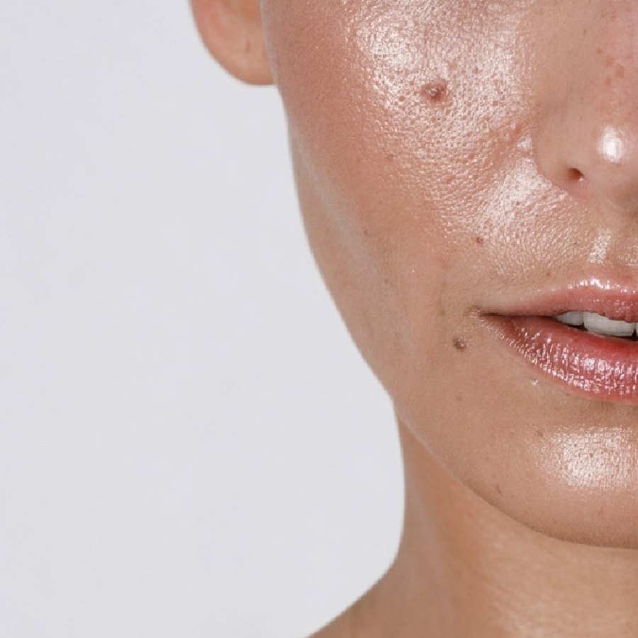 Skincare tips for oily and acne-prone skin during summer