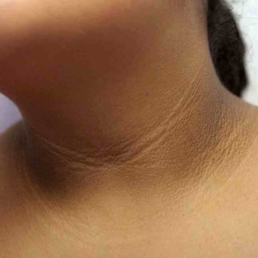 Dark lines on you neck, it indicates symptoms of Liver disease