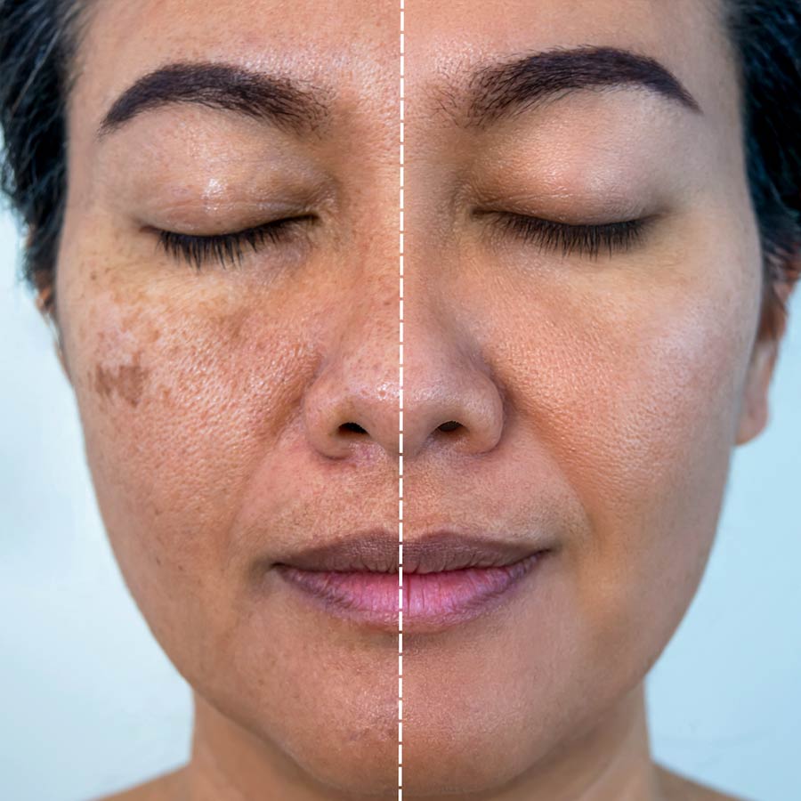 Old pigmentation could remove in two natural ingredients face pack dgtl