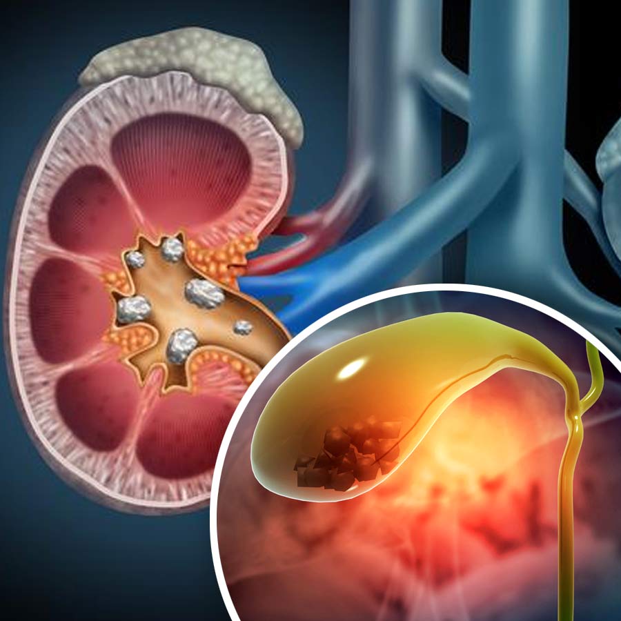 How to prevent kidney and gallbladder stone dgtl