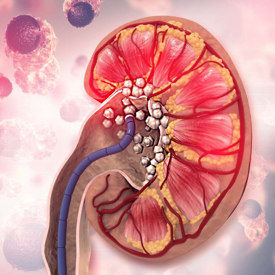 How to keep the risk of Kidney stone at bay by changing your food Habits dgtl