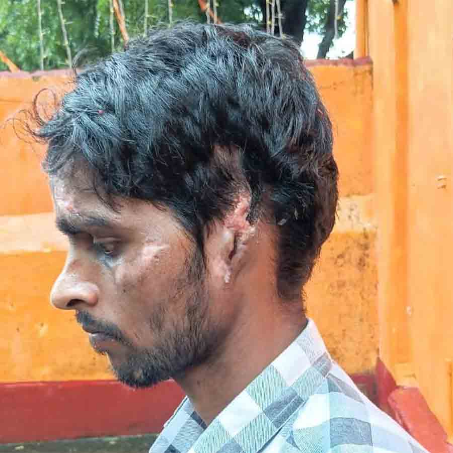 Contractor of Mumbai chopped off ears of a migrant labour who asked for his payment