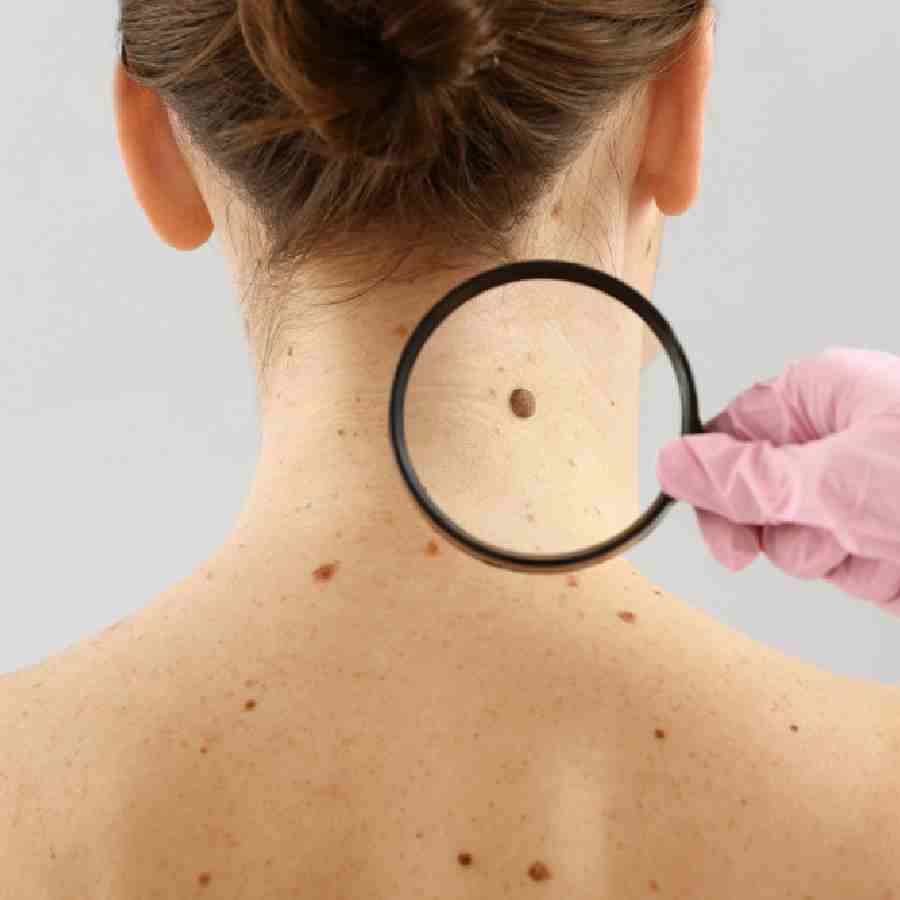 Dermatologist shares symptoms to check if your mole indicates skin cancer or not dgtl