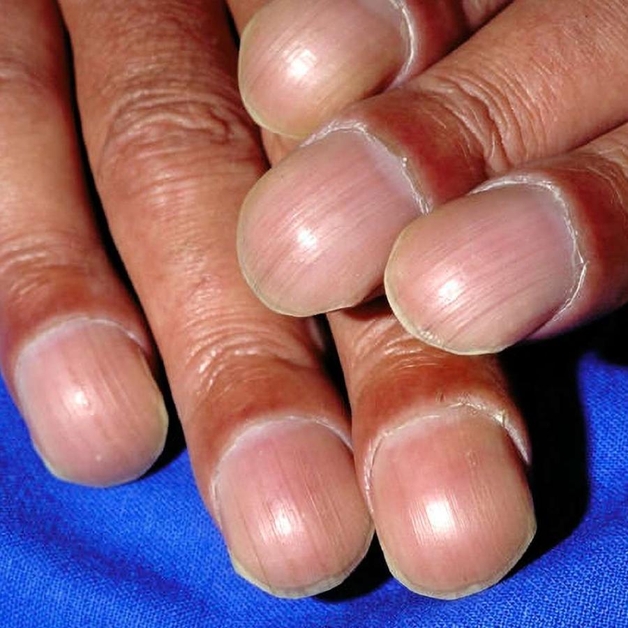What is nail clubbing, what diseases can this symptom indicate dgtl