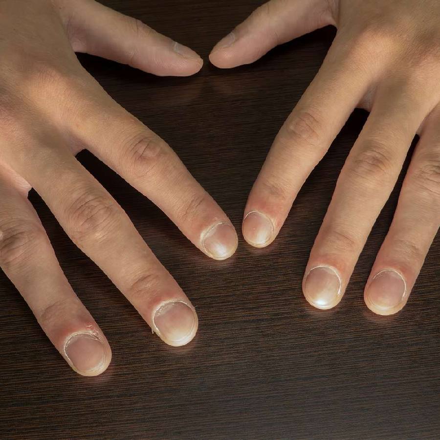 নখের ক্লাবিংয়ের কারণ কী?