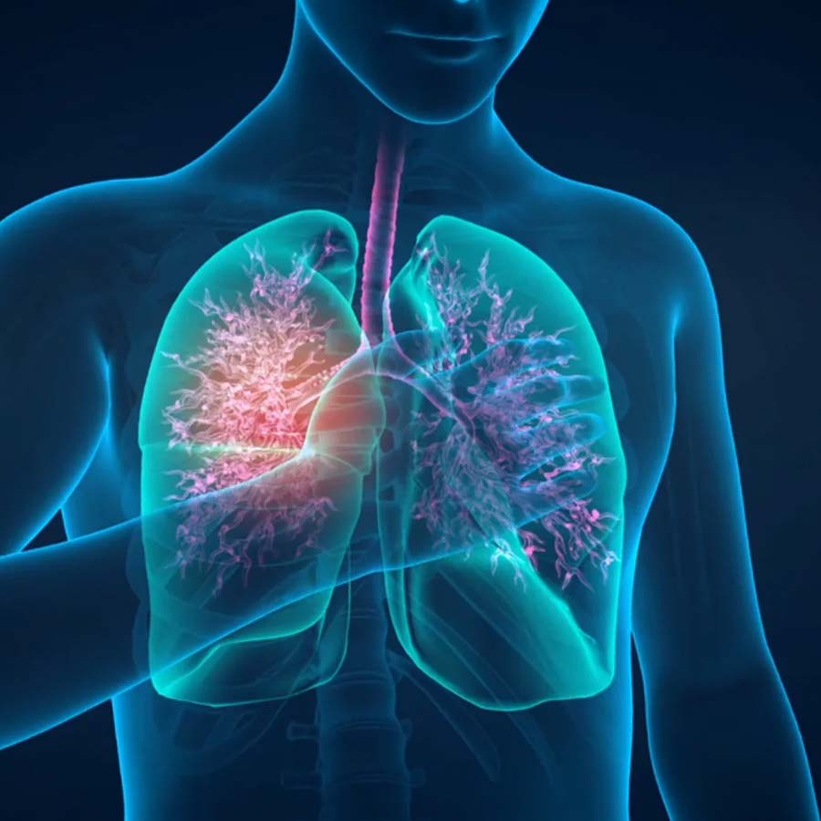 What is Bronchial thermoplasty, how this treatment use to treat severe asthma