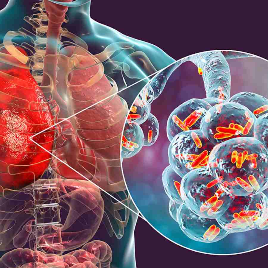 Legionnaires\\\' disease cluster in New York City causes 4th death, infected more than 100