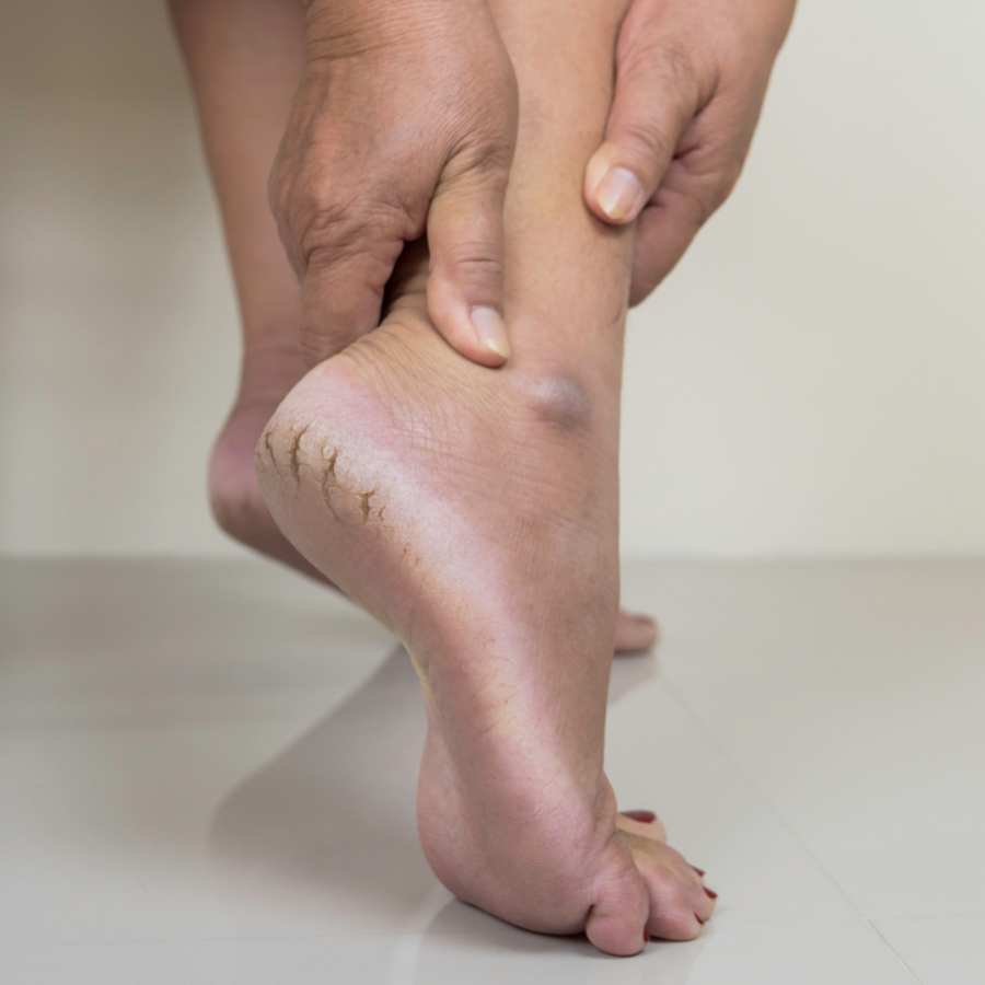 কেবল মরসুম বদল নয়, পা ফাটার নেপথ্যে থাকতে পারে কিছু শারীরিক সমস্যাও।