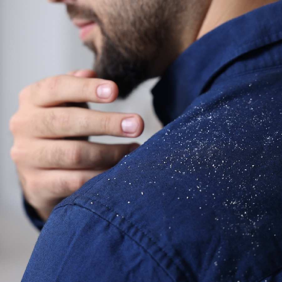 How to use camphor for dandruff treatment dgtl