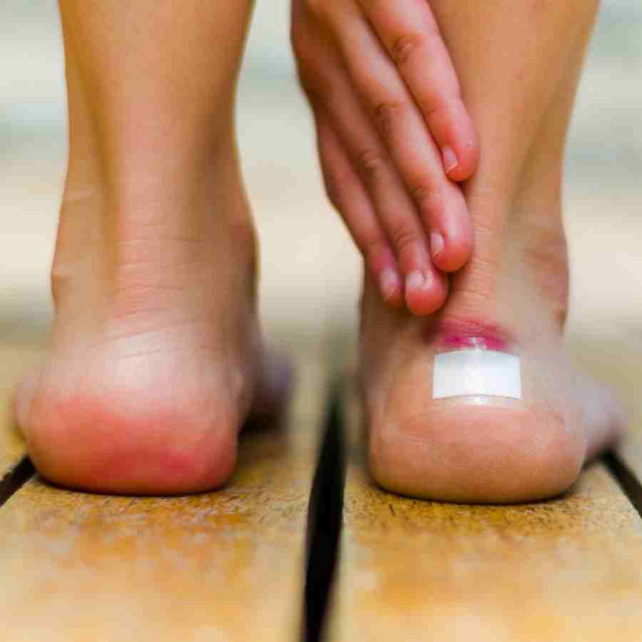 These are some natural remedies to heal blister safely at home