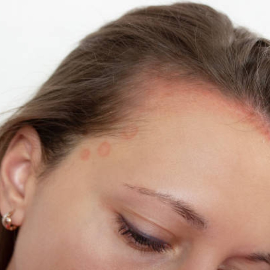 মাথার ত্বককে সুস্থ রাখাই সবার আগে প্রয়োজন।