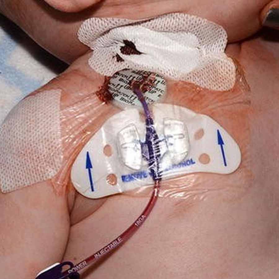 A study said Infections from medicine tubes in Indian hospitals high