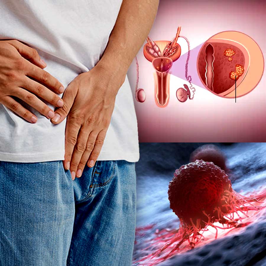 These are some warning signs of prostate cancer, how to recognize them dgtl