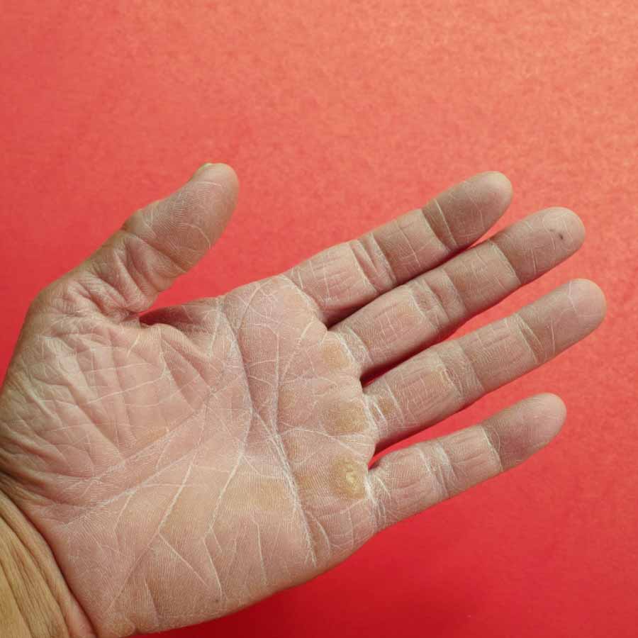 How to reduce dryness from hands during winter season dgtl