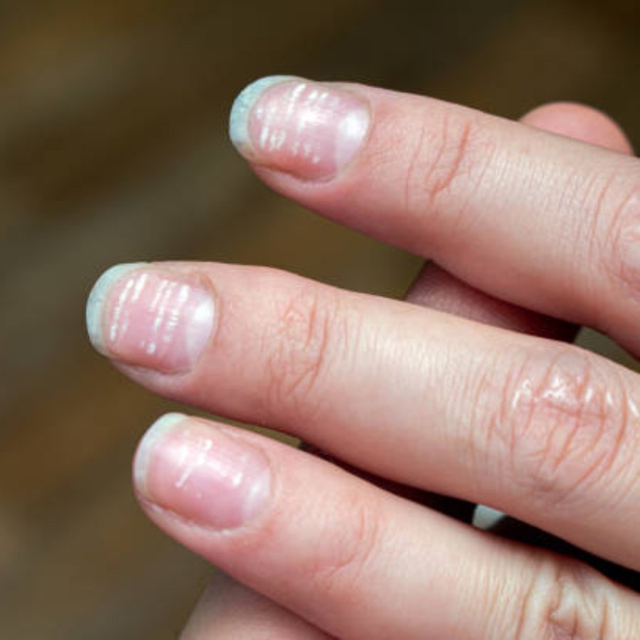 white spots on nail
