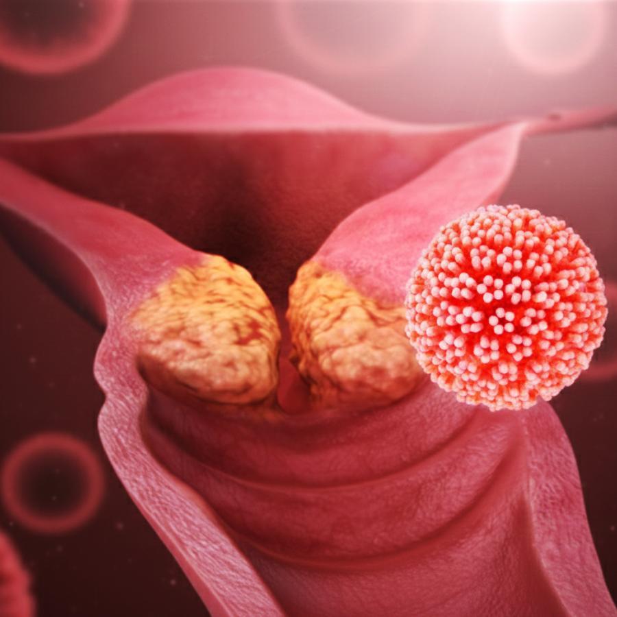 এই টিকার লক্ষ্য হিউম্যান প্যাপিলোমা ভাইরাসের তৈরি করা ক্যানসার ঘটানো প্রোটিন।