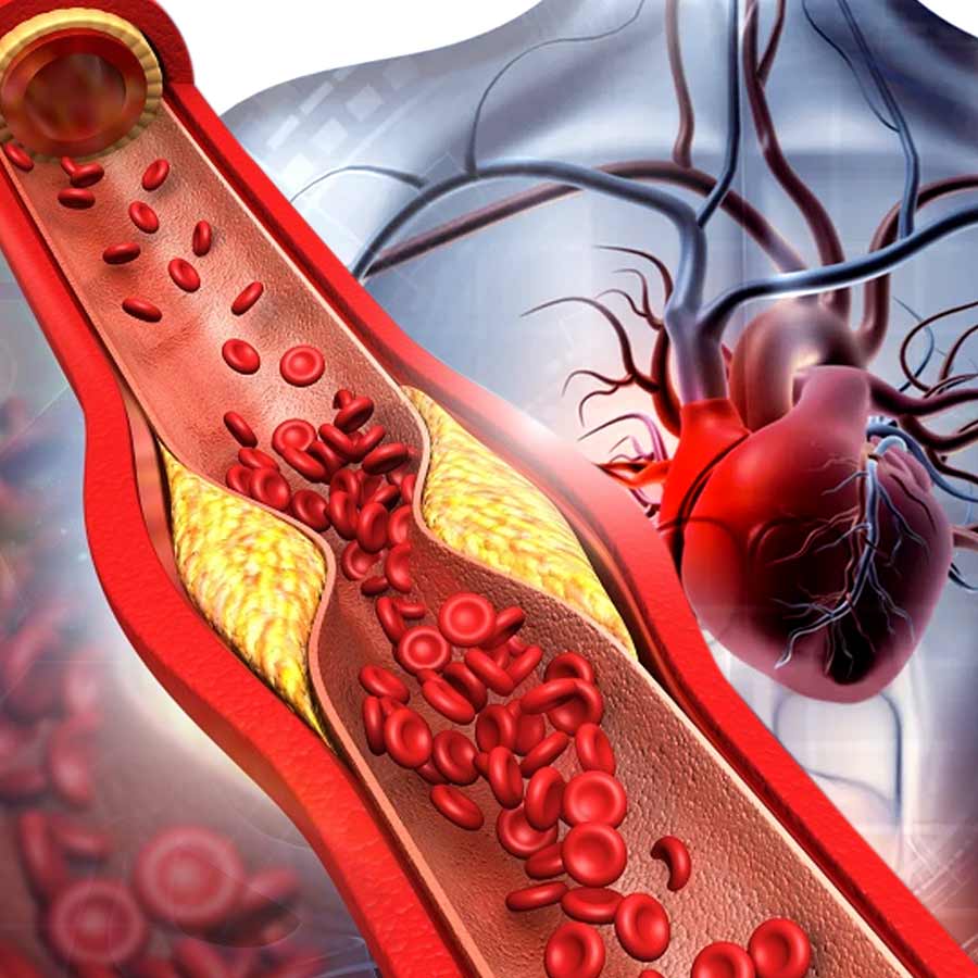 ধমনীতে প্ল্যাক জমছে অস্বাস্থ্যকর খাবারে।