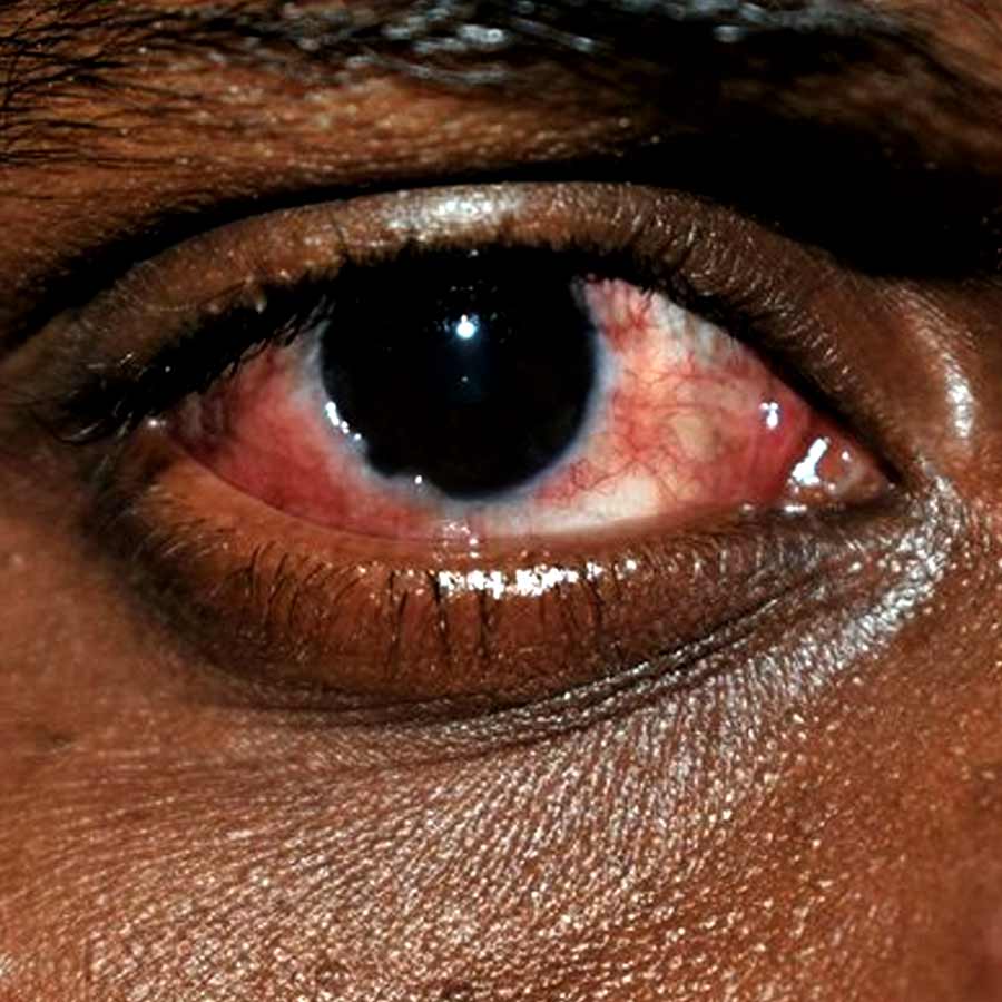 Air pollution is damaging eyes, doctors report a sharp rise in dryness, redness linked to toxic air