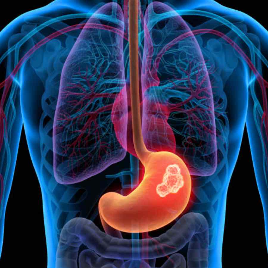 Follow these dietary habits to lower your risk of stomach cancer