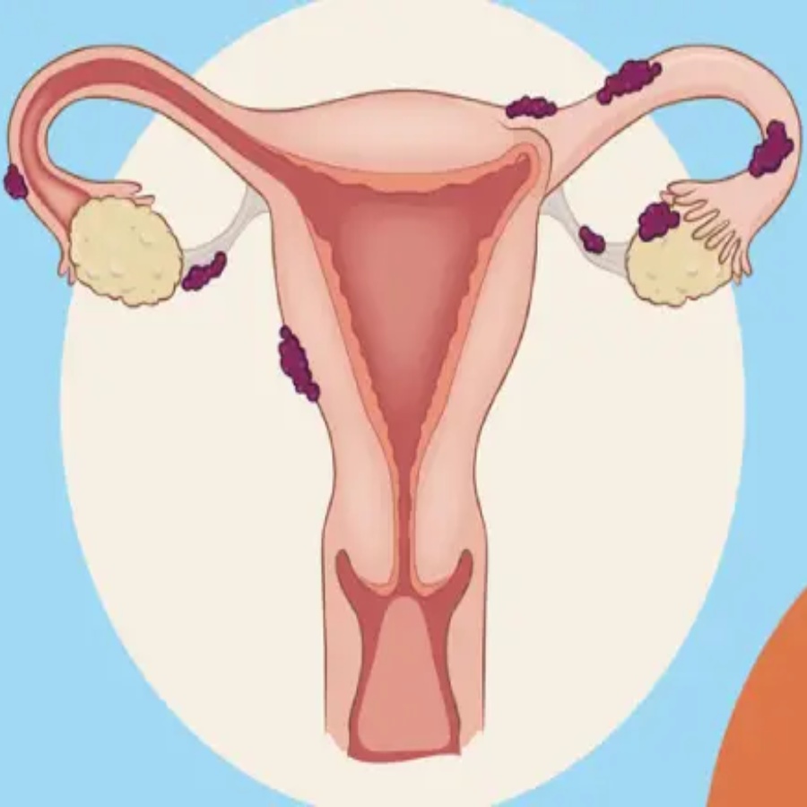 এন্ডোমেট্রিয়োসিস রোগ।