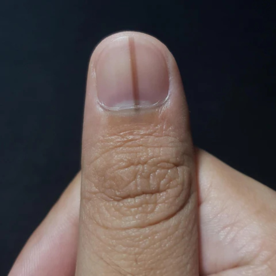 নখে লাল দাগ।