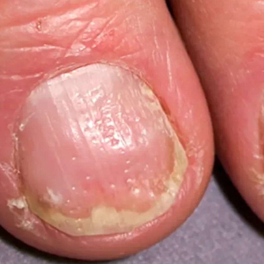 নখে ক্ষুদ্র গর্ত।