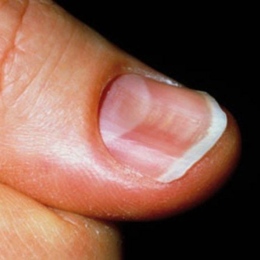 চামচের মতো নখ।