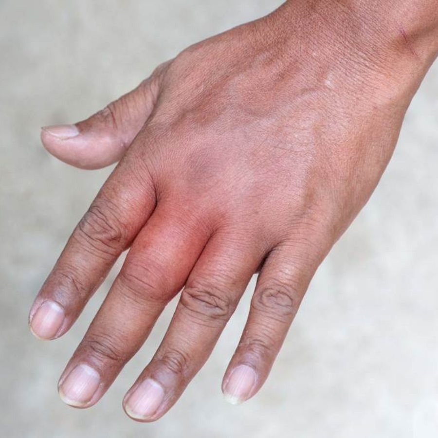 আঙুলের গাঁট ফুলে যাওয়া।