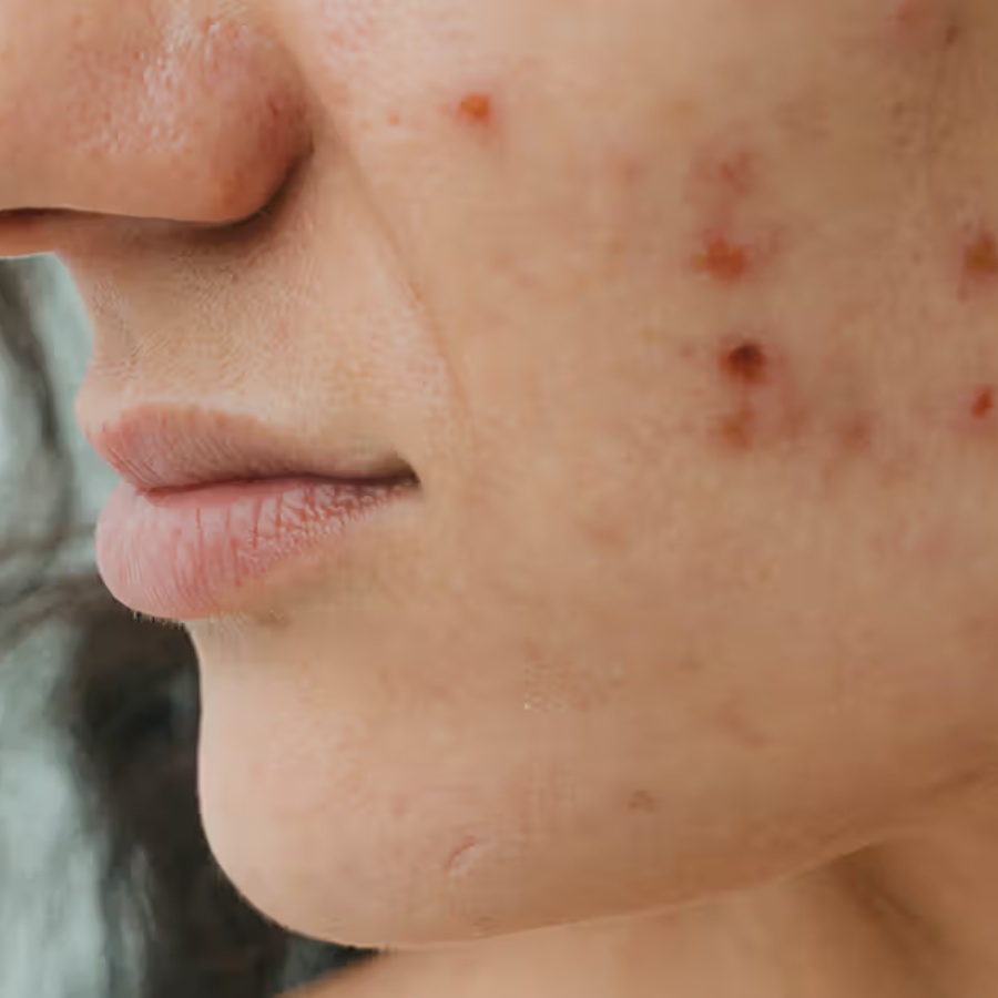 The effects on skin when the cortisol or stress hormone level is high dgtl