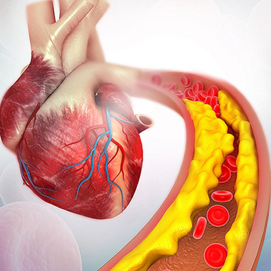 Heart attacks are often caused by hidden plaque, not just blockages dgtl