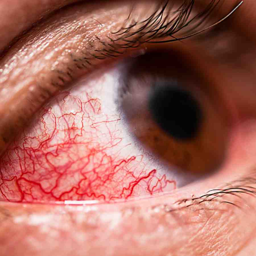 Why conjunctivitis more common in Winter