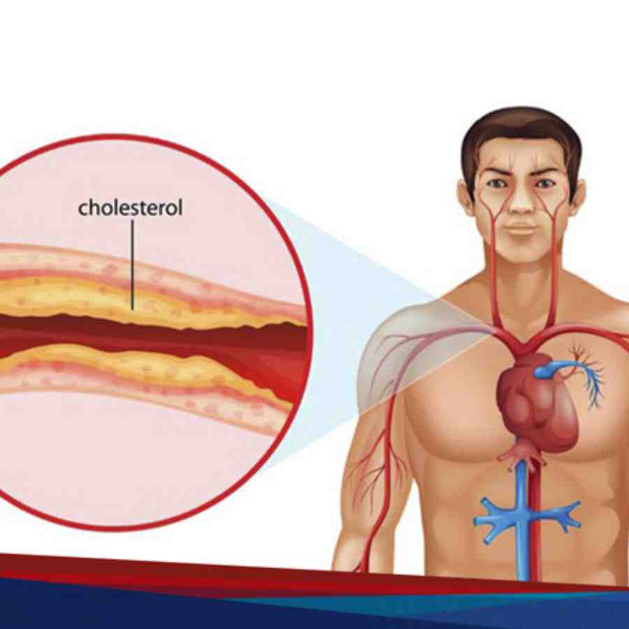 What causes low cholesterol, what are the symptoms and prevention tips