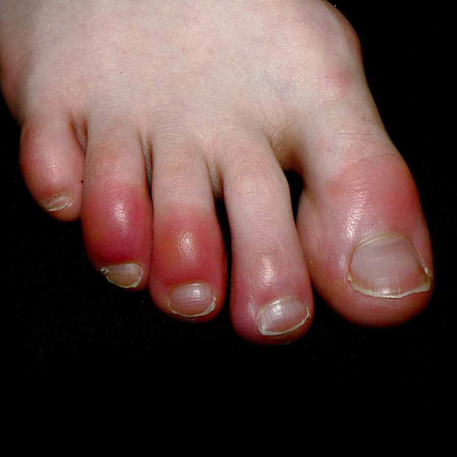 How to protect your feet in cold weather