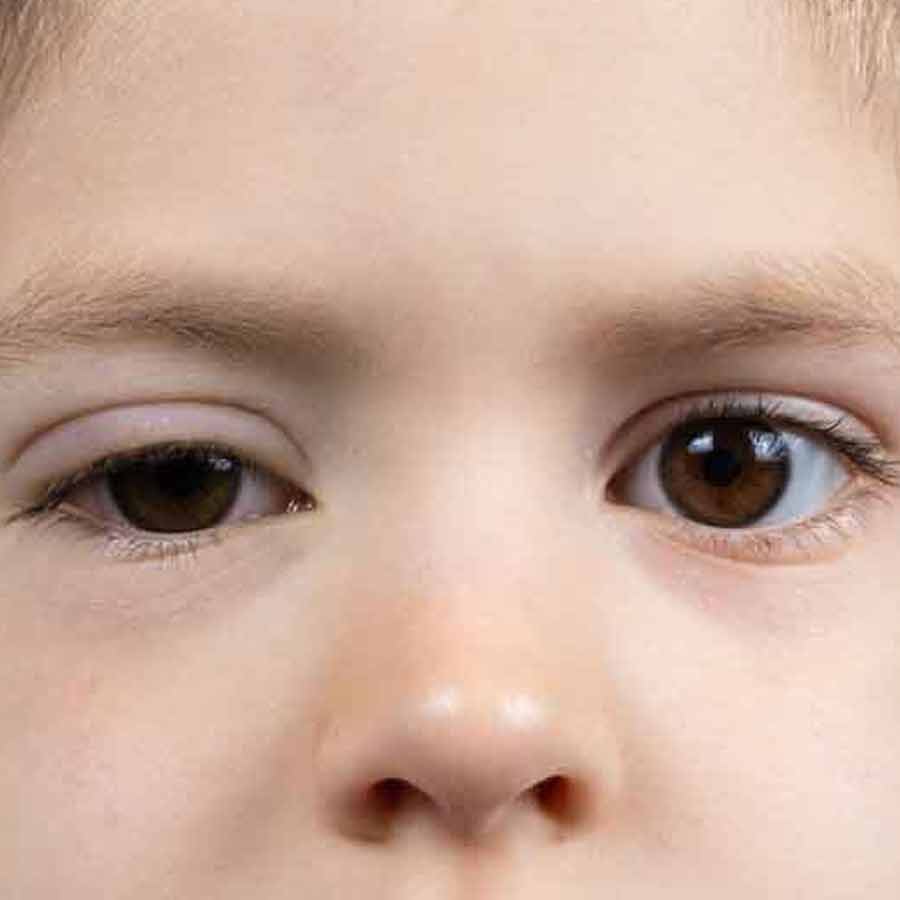 What is Marcus Gunn Syndrome, understanding the symptoms and risks of this rare disease