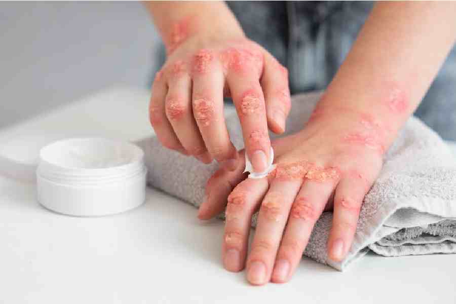What is the reason of dry skin between two fingers dgtl