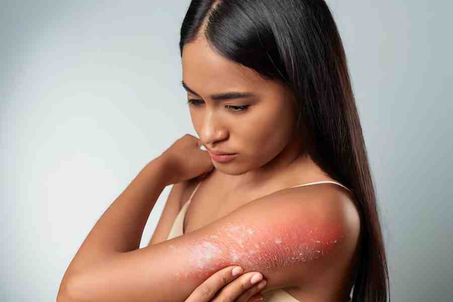 Essential oils may help to relieve symptoms of psoriasis and other skin infections