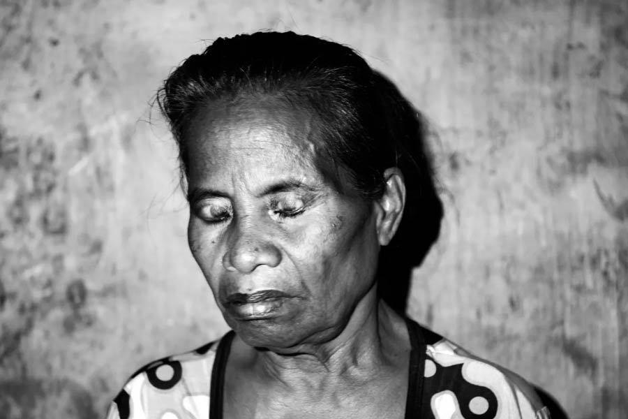 King of Pingelap Atoll Acts to Preserve Uninhabited Island as Rare Diseases Pass Through Generations