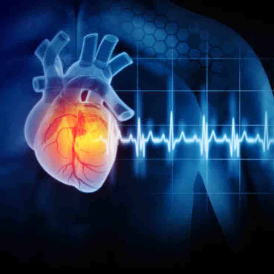 Dextrocardia is a rare congenital condition where the heart is positioned on the right side of the chest